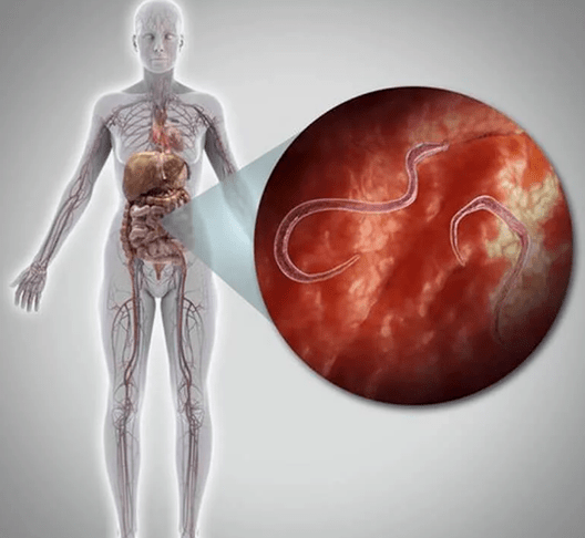 Parasites in the human body