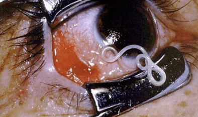 Types of pests in the human body